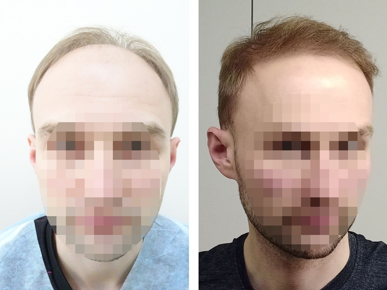 Наши работы по пересадке волос | HairMed, г. Минск