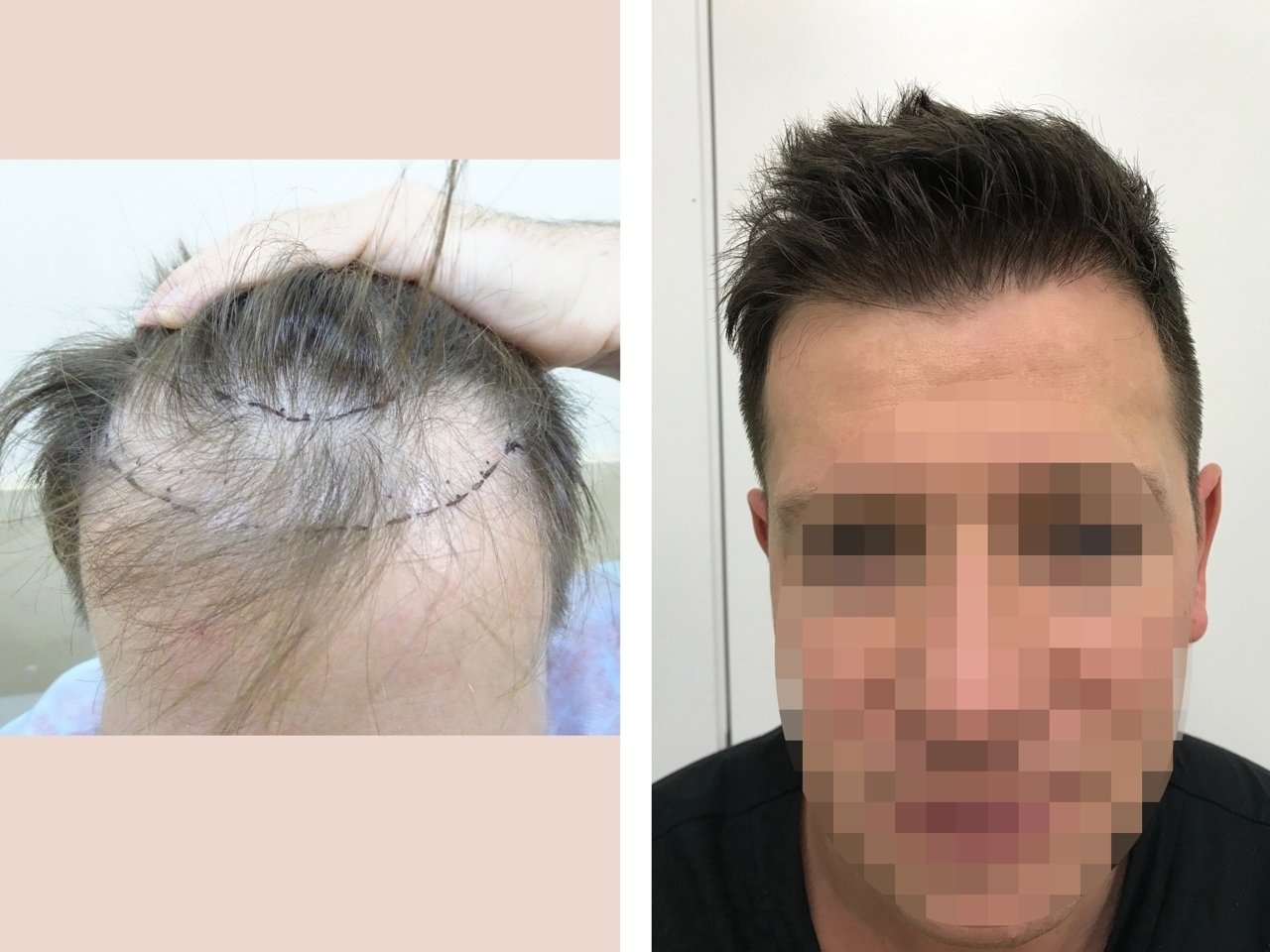 Наши работы по пересадке волос | HairMed, г. Минск